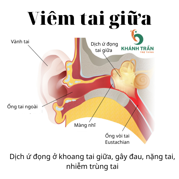 tại sao viêm tai giữa